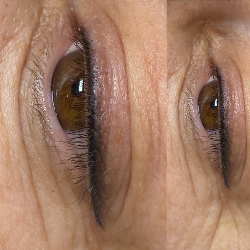 Kecskemét Dékány Adrienn sminktetoválás lézer hegkezelés