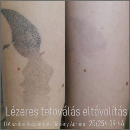 Teljes tetoválás eltávolítás- utolsó kezelés ELŐTTI eredmény