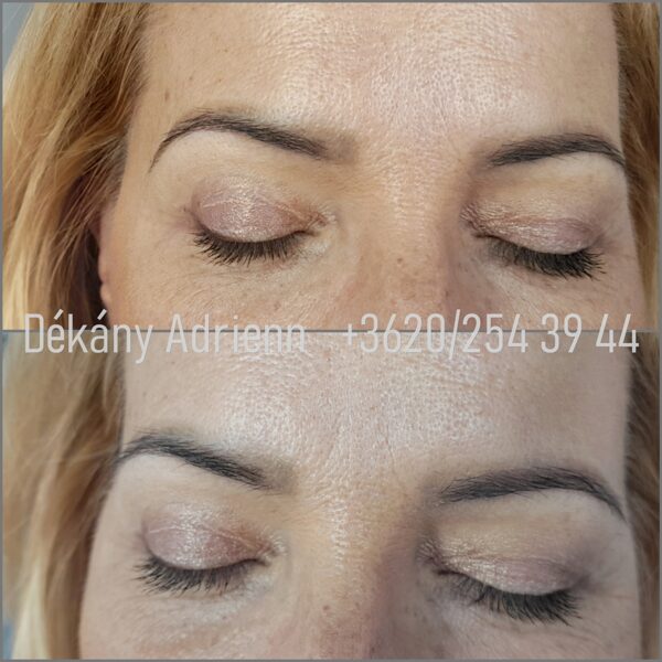 2 lézeres kezelés eredménye