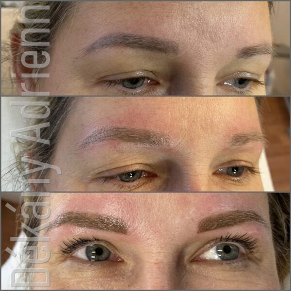 Régi tetoválás felújítása- lézeres kezelés után