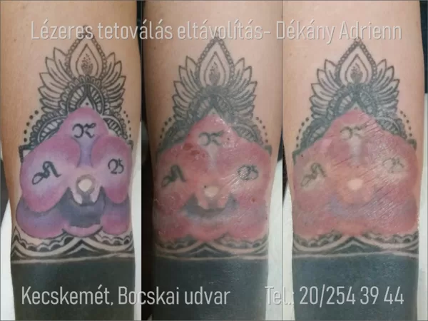 ALLERGIÁS reakció miatti tetoválás eltávolítás! Folyamatban.....
