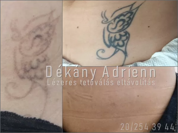 Teljes tetoválás eltávolítás