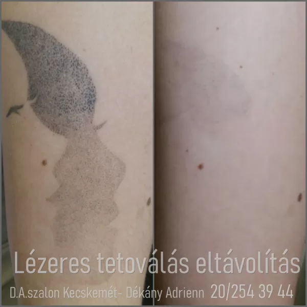 Teljes tetoválás eltávolítás- utolsó kezelés ELŐTTI eredmény