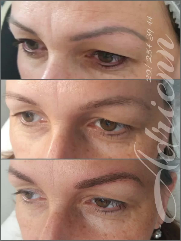 Testtetováló festékkel készült szemöldök lézerezése egy alkalommal, utána microblading 